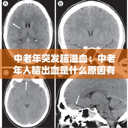 中老年突發(fā)腦溢血：中老年人腦出血是什么原因有哪些 